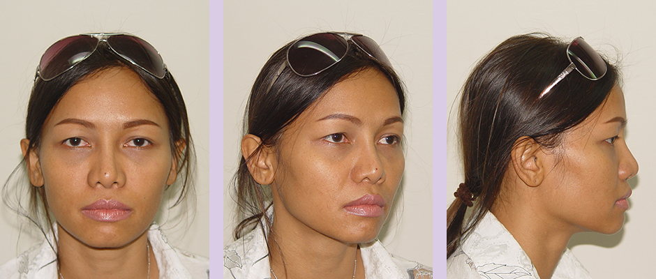Cosmetic-facial-implant-surgery-by-doctor-Chettawut-Gallery-Case-2-after-nose-implant-and-alarplasty-surgery