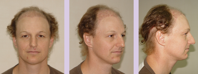 Doctor-Chettawut-full-facial-feminization-work-case-4-before-surgery