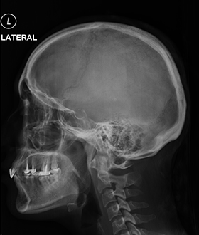 Example-of-skull-x-ray-side-view