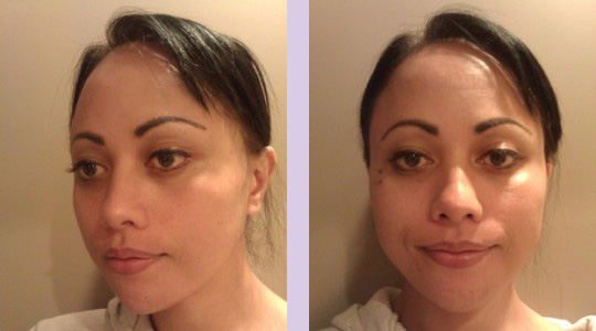 FFS3-Brow-bone-bossing-reduction+Jaw-and-Chin-contouring-surgery-after