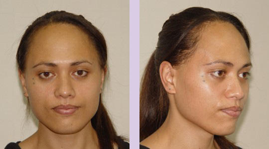 FFS3-Brow-bone-bossing-reduction+Jaw-and-Chin-contouring-surgery-before