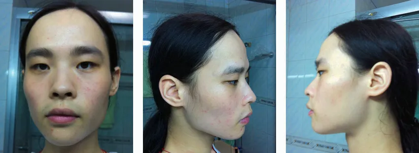 FFS Gallery C - Before and After Surgery Case 3 22 years old patient from Singapore Before