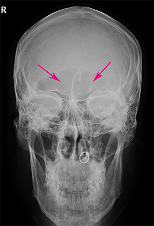 Forehead-type-3-skull-x-ray-AP-view