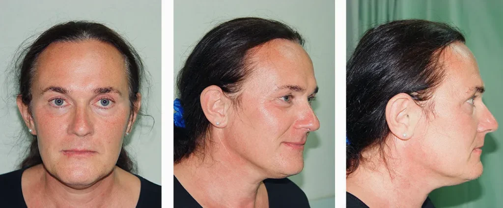 FFS Gallery D - Before and After Surgery Case 2 52 years old patient from Denmark Before