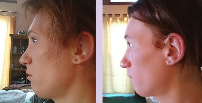 Result-of-forehead-contouring-surgery-by-Chettawut-MD-left
